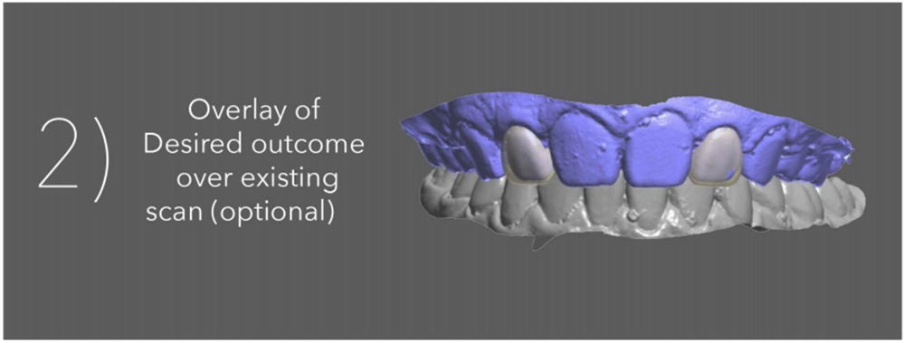 Crown and Bridge - Sending a Smile Design Case to the 3Shape Design ...